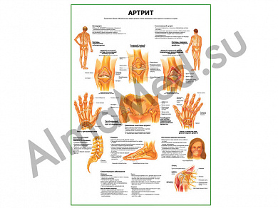 Артрит плакат ламинированный А1/А2 (ламинированный A2)