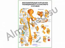 Воспалительные нарушения тазобедренного и коленного суставов плакат ламинированный А1/А2 (ламинированный A2)