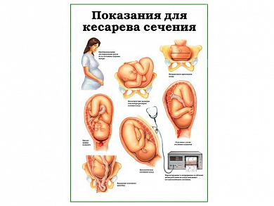 Показания для кесарева сечения, плакат глянцевый А1/А2 (глянцевый A2)