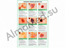 Меланома, примеры для практики, плакат глянцевый/ламинированный А1/А2 (глянцевый A2)
