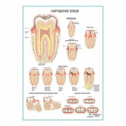 Нарушения зубов плакат глянцевый А1+/А2+ (глянцевая фотобумага от 200 г/кв.м, размер A2+)