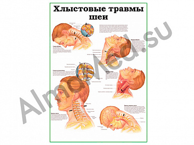 Хлыстовые травмы шеи, плакат ламинированный А1/А2 (ламинированный A2)