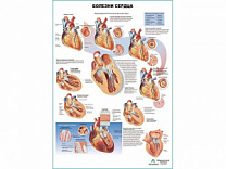 Болезни сердца, плакат глянцевый А1/А2 (глянцевый A2)