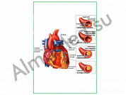 Развитие атеросклероза, плакат глянцевый/ламинированный А1/А2 (глянцевый A2)