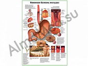 Язвенная болезнь желудка плакат глянцевый/ламинированный А1/А2 (глянцевый A2)
