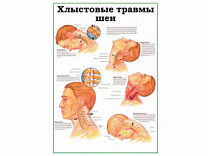 Хлыстовые травмы шеи, плакат глянцевый  А1/А2 (глянцевый A1)