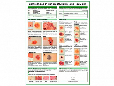 Меланома, диагностика, плакат глянцевый А1/А2 (глянцевый A2)