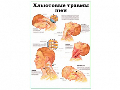 Хлыстовые травмы шеи, плакат глянцевый  А1/А2 (глянцевый A1)