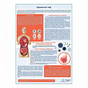 Брюшной тиф медицинский плакат А1+/A2+ (глянцевый холст от 200 г/кв.м, размер A1+)