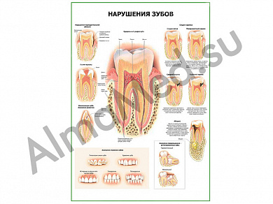 Нарушения зубов плакат ламинированный А1/А2 (ламинированный A2)