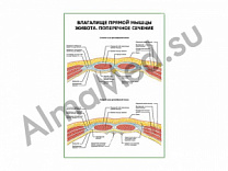 Влагалище прямой мыщцы живота. Поперечное сечение плакат ламинированный А1/А2 (ламинированный	A2)