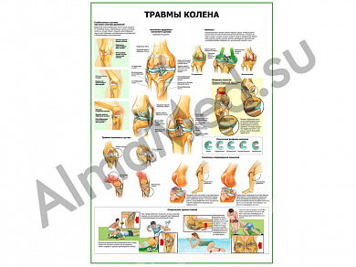 Травмы колена плакат глянцевый/ламинированный А1/А2 (глянцевый A2)