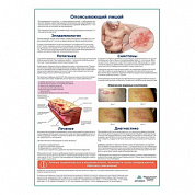 Опоясывающий лишай медицинский плакат А1+/A2+ (глянцевая фотобумага от 200 г/кв.м, размер A1+)