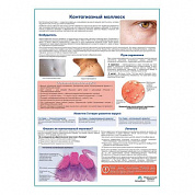 Контагиозный моллюск медицинский плакат А1+/A2+ (глянцевая фотобумага от 200 г/кв.м, размер A1+)