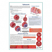 Туберкулёз медицинский плакат А1+/A2+ (глянцевая фотобумага от 200 г/кв.м, размер A2+)