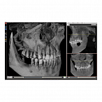 Fona XPan 3D - рентгенографическая цифровая система панорамной съемки