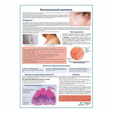 Контагиозный моллюск медицинский плакат А1+/A2+ (глянцевая фотобумага от 200 г/кв.м, размер A2+)