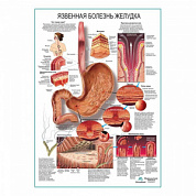 Язвенная болезнь желудка плакат глянцевый А1+/А2+ (глянцевая фотобумага от 200 г/кв.м, размер A2+)