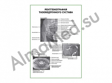 Рентгенография тазобедренного сустава плакат глянцевый/ламинированный А1/А2 (глянцевый	A2)