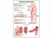 Полипы кишечника плакат глянцевый  А1/А2 (глянцевый A1)
