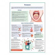 Кандидоз медицинский плакат А1+/A2+ (матовый холст от 200 г/кв.м, размер A1+)