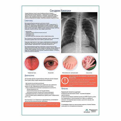 Синдром Кавасаки медицинский плакат А1+/A2+ (глянцевая фотобумага от 200 г/кв.м, размер A1+)