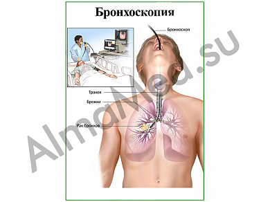 Бронхоскопия, плакат ламинированный А1/А2 (ламинированный	A2)