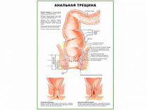 Анальная Трещина плакат глянцевый  А1/А2 (глянцевый A2)