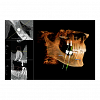 Instrumentarium OP 3D Vision V8 - панорамный томограф
