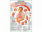 Гипертония плакат глянцевый А1/А2 (глянцевый A2)