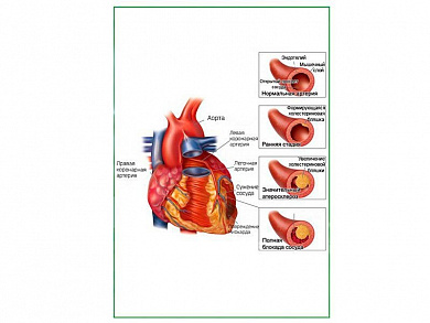 Развитие атеросклероза, плакат глянцевый А1/А2 (глянцевый A1)