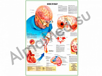 Инсульт, плакат глянцевый/ламинированный А1/А2 (глянцевый A2)