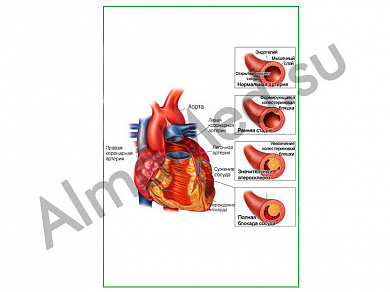 Развитие атеросклероза, плакат ламинированный А1/А2 (ламинированный A2)