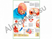 Инсульт, плакат ламинированный А1/А2 (ламинированный A2)
