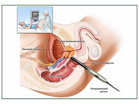 УЗИ предстательной железы, плакат глянцевый А1/А2 (глянцевый A2)