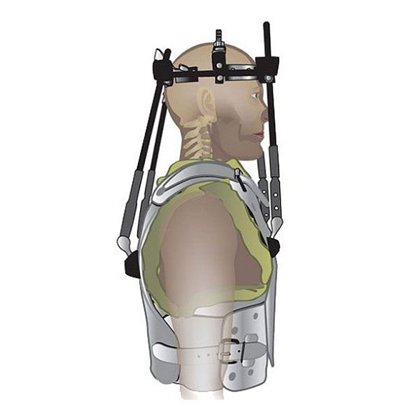 Аппарат "Halo-cast "ЦИТО"-L (большой размер)