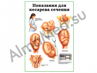 Показания для кесарева сечения, плакат ламинированный А1/А2 (ламинированный A2)