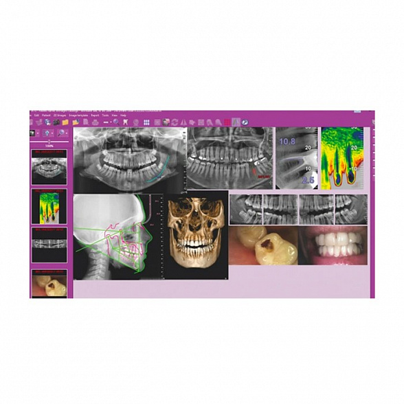 Hyperion X9 Pro 11x13 Ceph Titanium - дентальный цифровой 3D-томограф с цефалостатом, 3 в 1, FOV 11x13