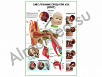 Заболевания среднего уха (отит) плакат глянцевый/ламинированный А1/А2 (глянцевый A2)