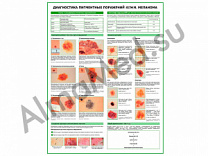 Меланома, диагностика, плакат глянцевый/ламинированный А1/А2 (Ламинированный А2)