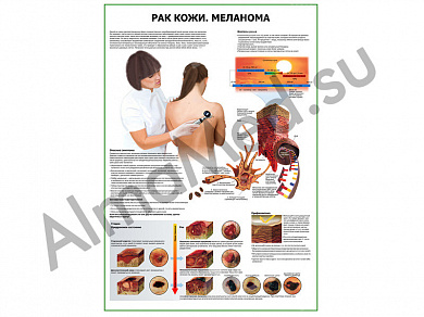 Рак кожи меланома плакат ламинированный А1/А2 (ламинированный A2)