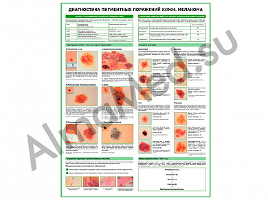 Меланома, диагностика, плакат глянцевый/ламинированный А1/А2 (Ламинированный А2)