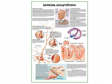 Болезнь Альцгеймера плакат глянцевый А1/А2 (глянцевый A1)