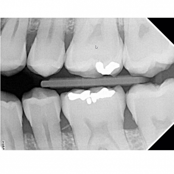 Satelec Комплект рентген и визиограф - рентгеновский аппарат X-Mind DC 80 и визиограф Sopix2 (Франция)