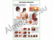 Рак кожи меланома плакат ламинированный А1/А2 (ламинированный A2)