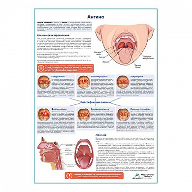 Ангина медицинский плакат А1+/A2+ (глянцевая фотобумага от 200 г/кв.м, размер A2+)