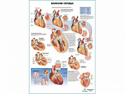 Болезни сердца, плакат глянцевый А1/А2 (глянцевый холст от 200 г/кв.м, размер A1+)