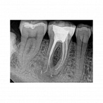 Carestream Dental RVG 6200 - радиовизиограф, 24 пар линий/мм
