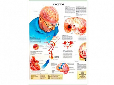 Инсульт, плакат глянцевый А1/А2 (глянцевый A2)