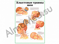 Хлыстовые травмы шеи, плакат ламинированный А1/А2 (ламинированный A2)